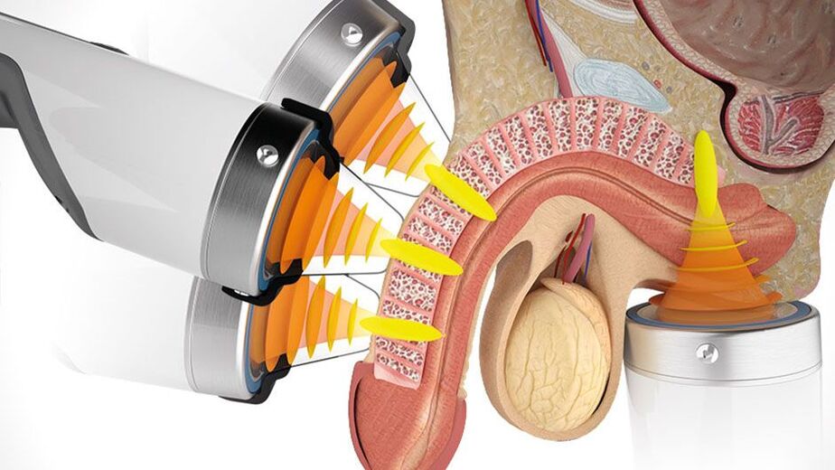 Stages of penis enlargement surgery