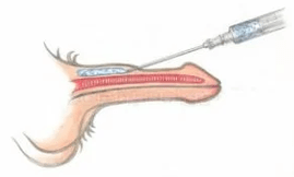 Hyaluronic acid injection